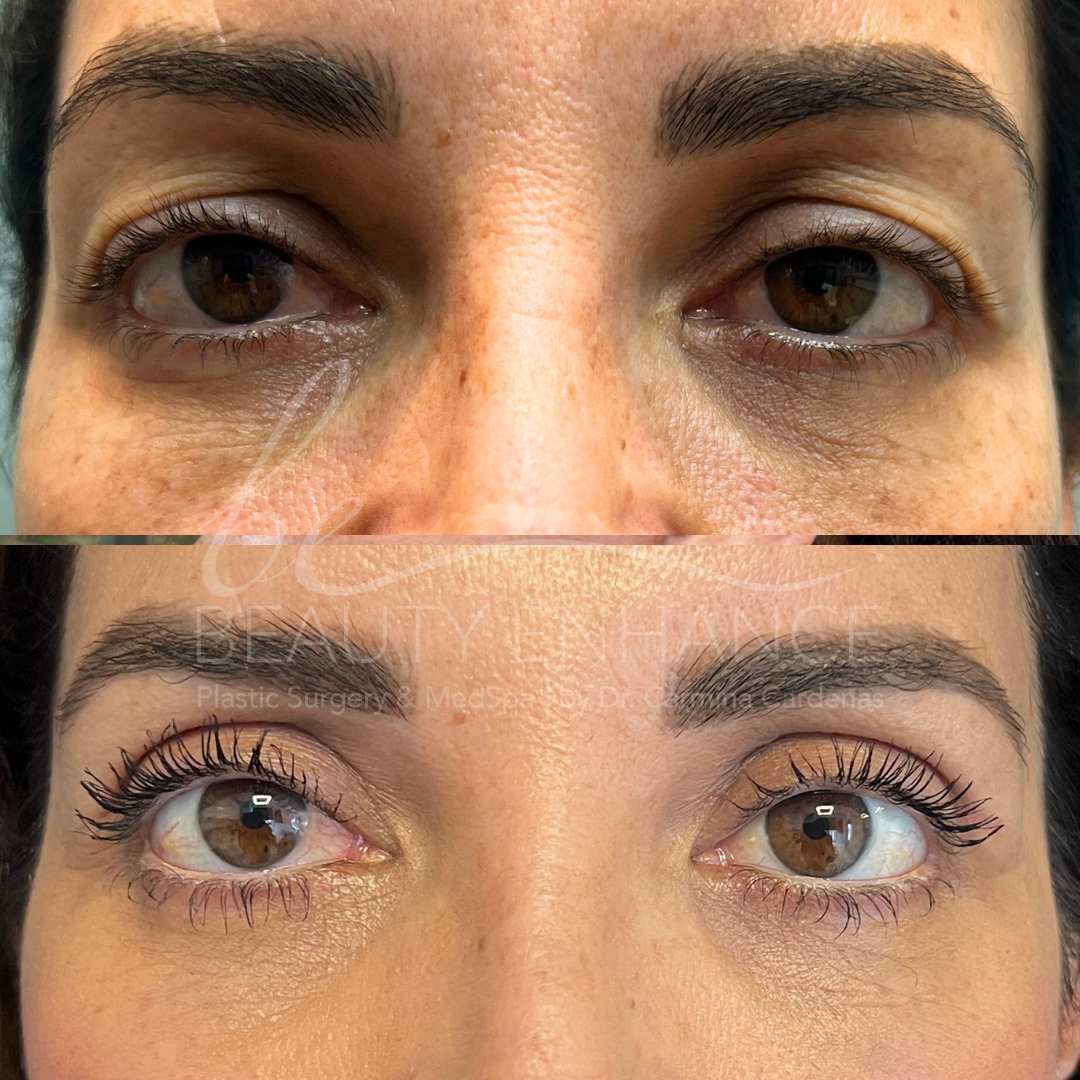Blepharoplasty — approved patient result 1