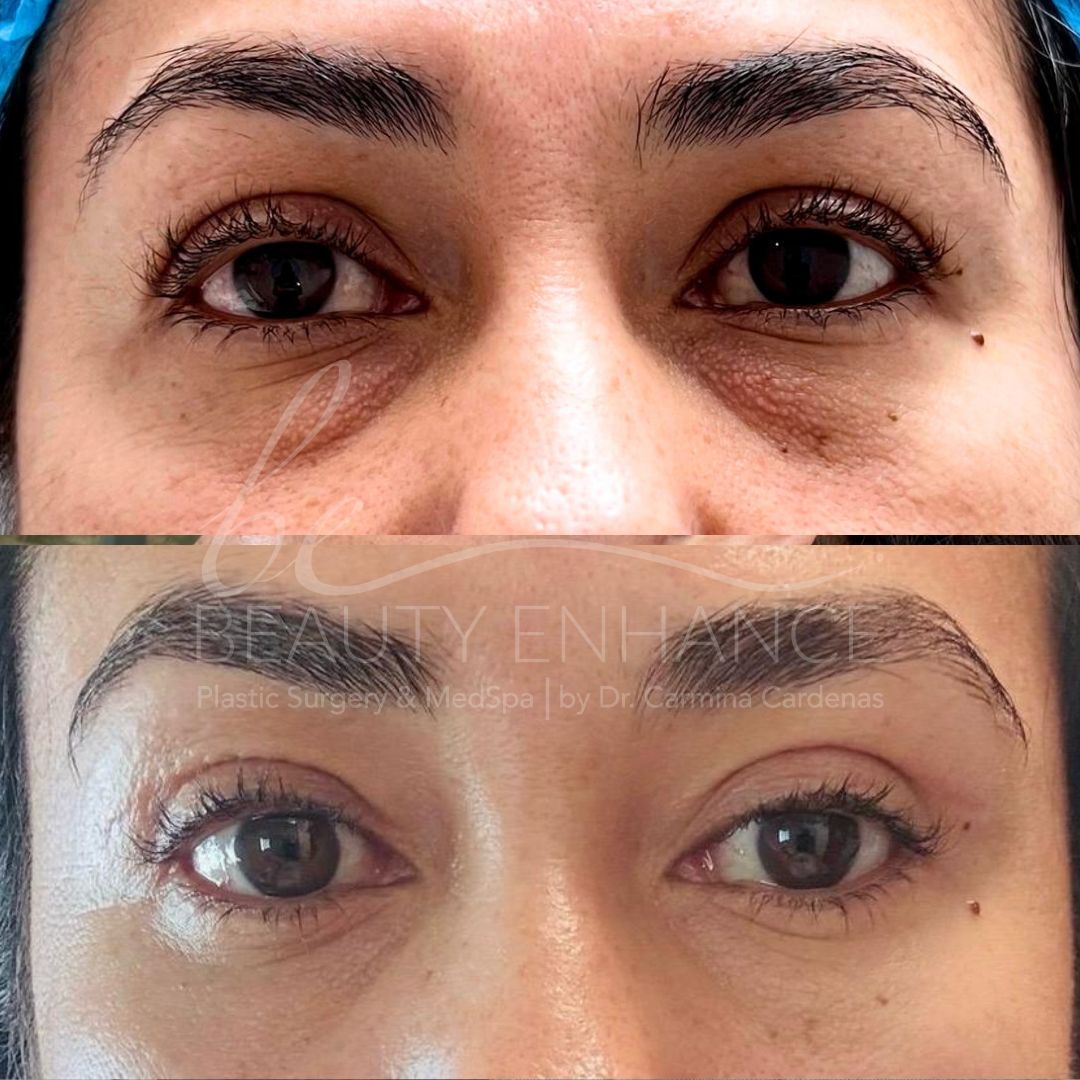 Blepharoplasty — approved patient result 2