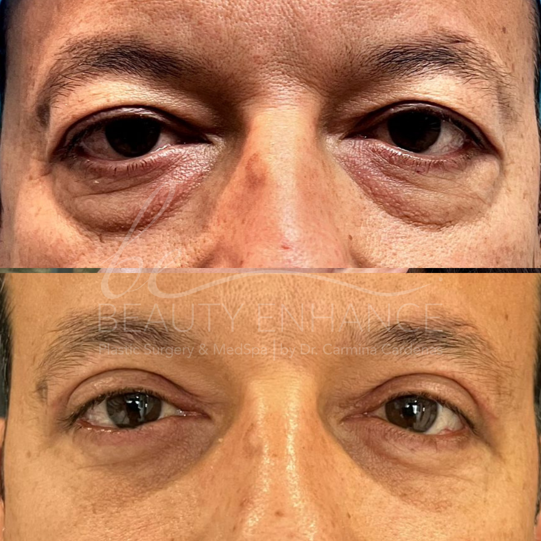 Blepharoplasty — approved patient result 3