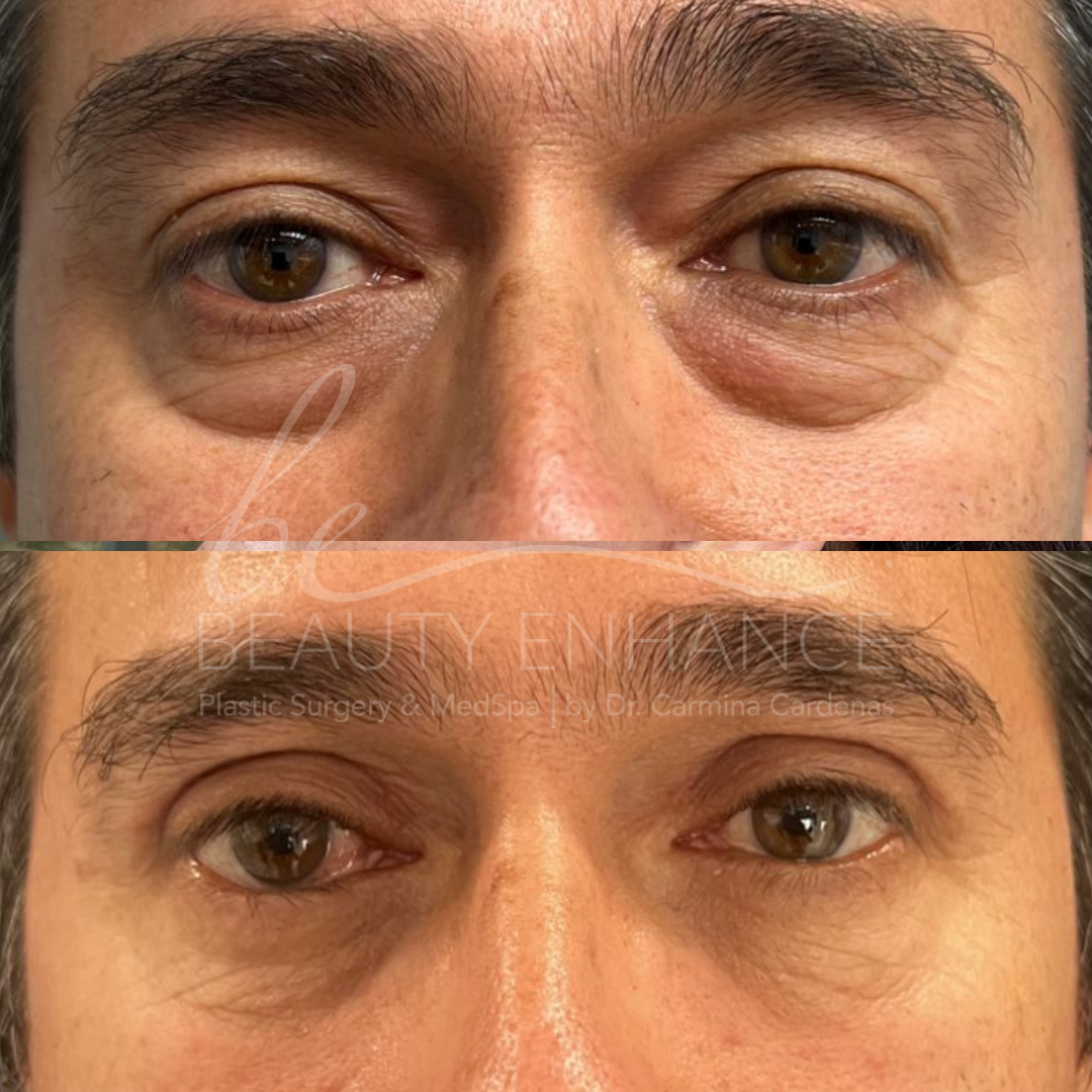 Blepharoplasty — approved patient result 4