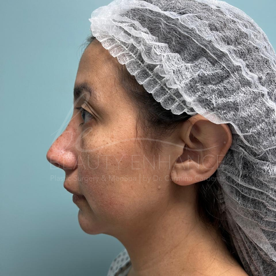 Royal Deep Plane Full Face Lift — approved patient result 1