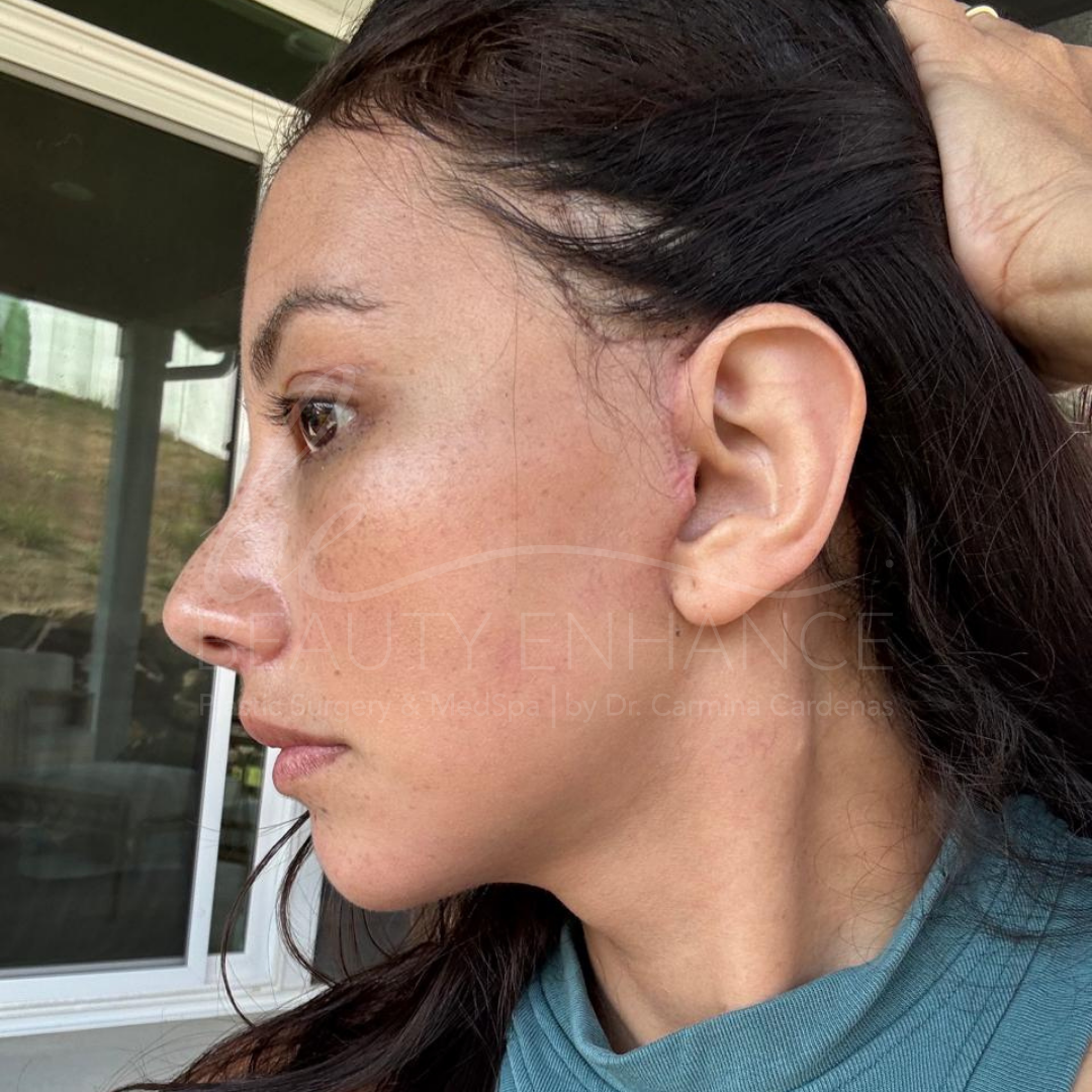 Royal Deep Plane Full Face Lift — approved patient result 2