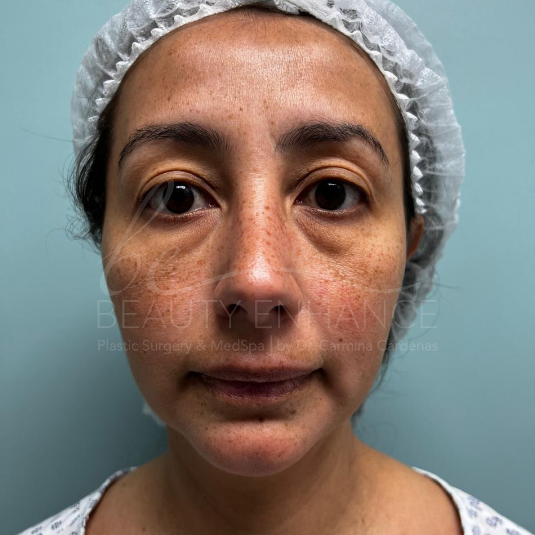 Royal Deep Plane Full Face Lift — approved patient result 3