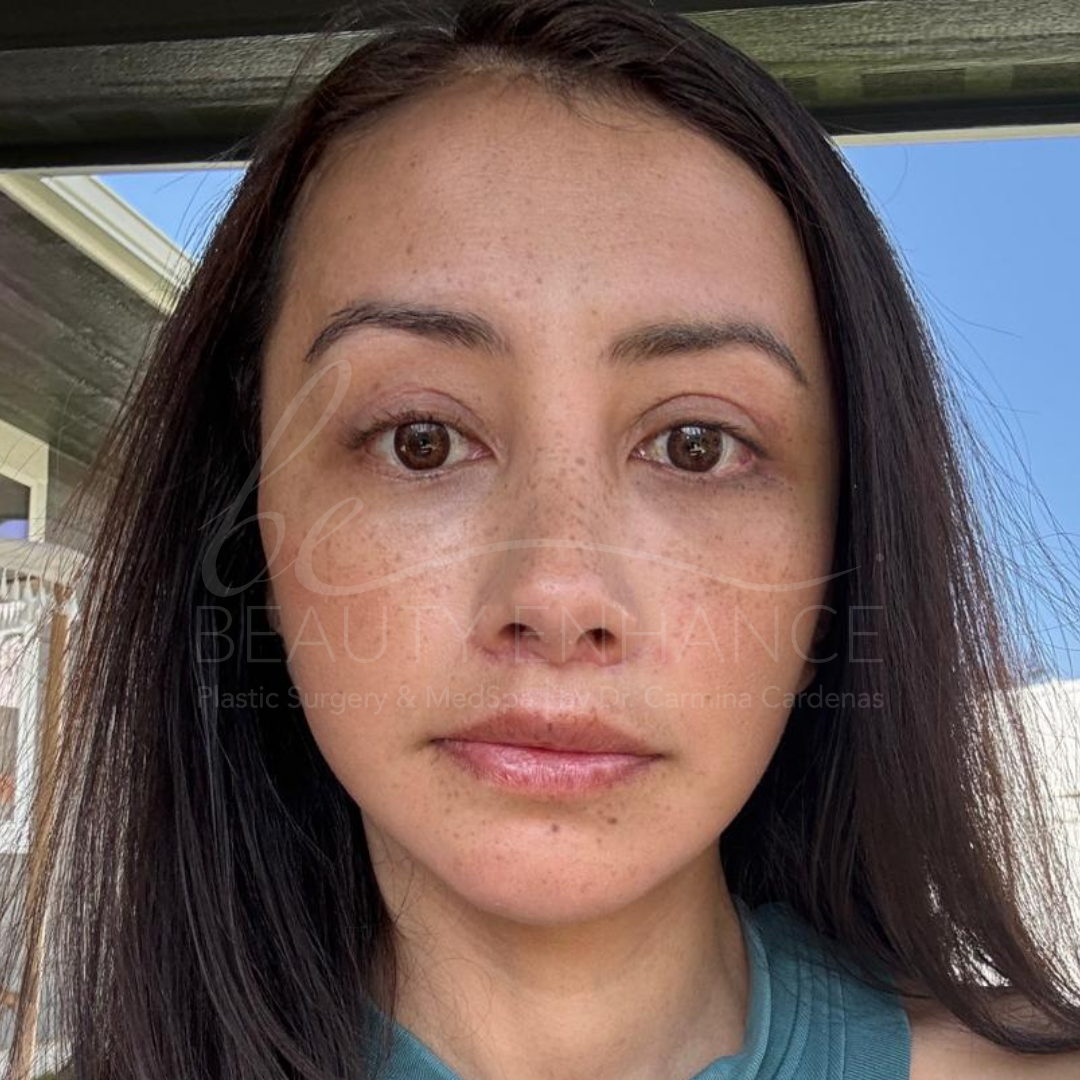 Royal Deep Plane Full Face Lift — approved patient result 4